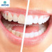2015 hot sale SUV approved teeth whitening strips