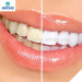 Alibaba Express One-minute effect Teeth Whitening Distributors Agents Required