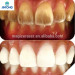 Dental Products Biaya Pemutihan Gigi tooth whitening Kit